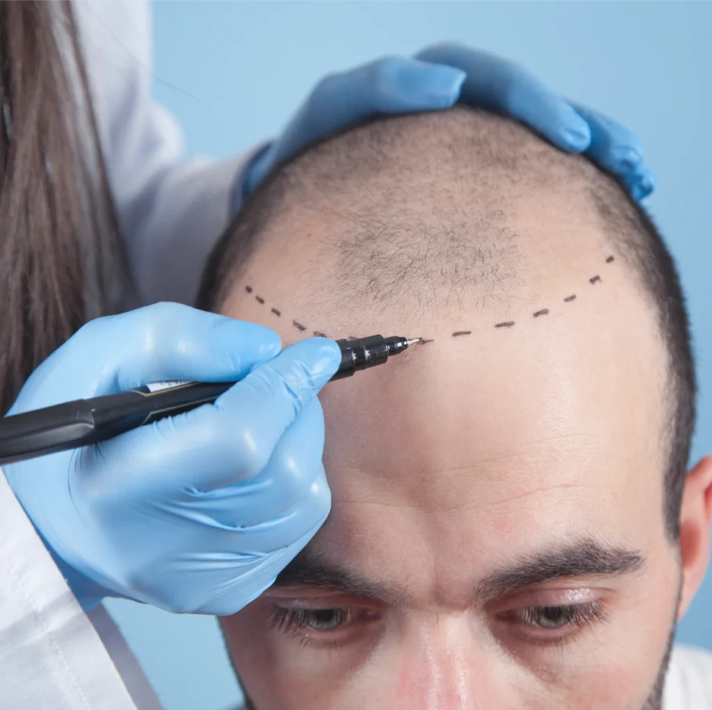 La Densitae Hair Transplant history